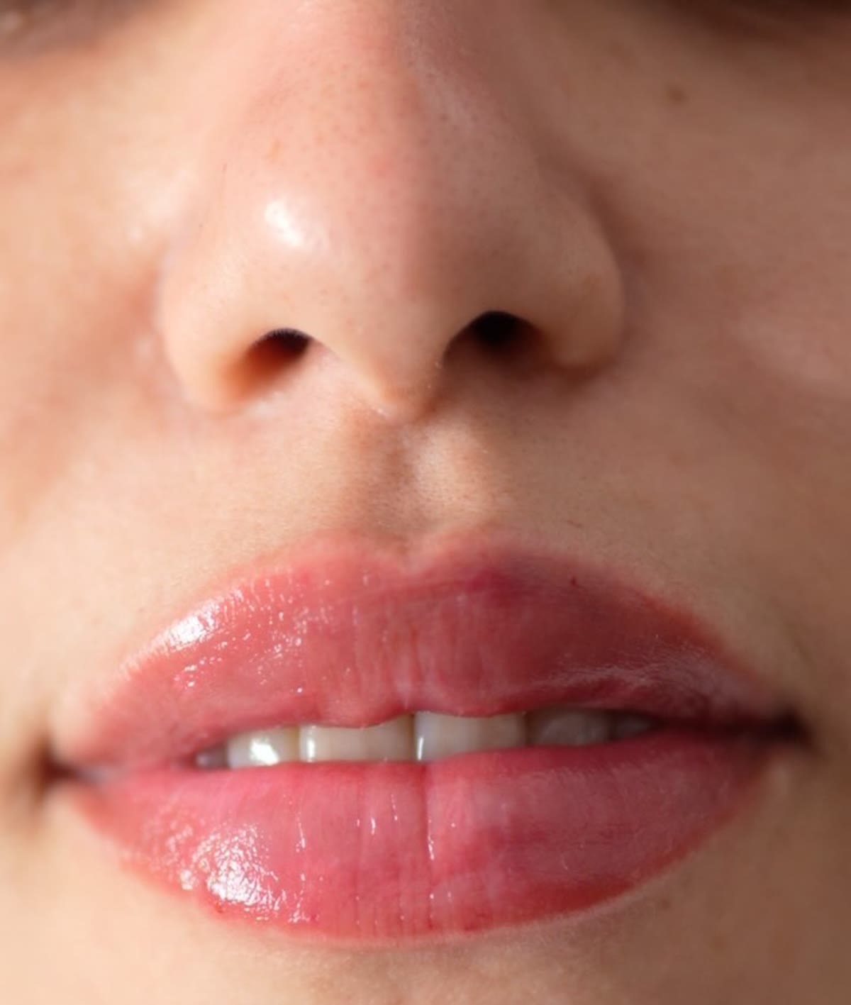 Botox and filler treatment at Swiss Aesthetic Clinic